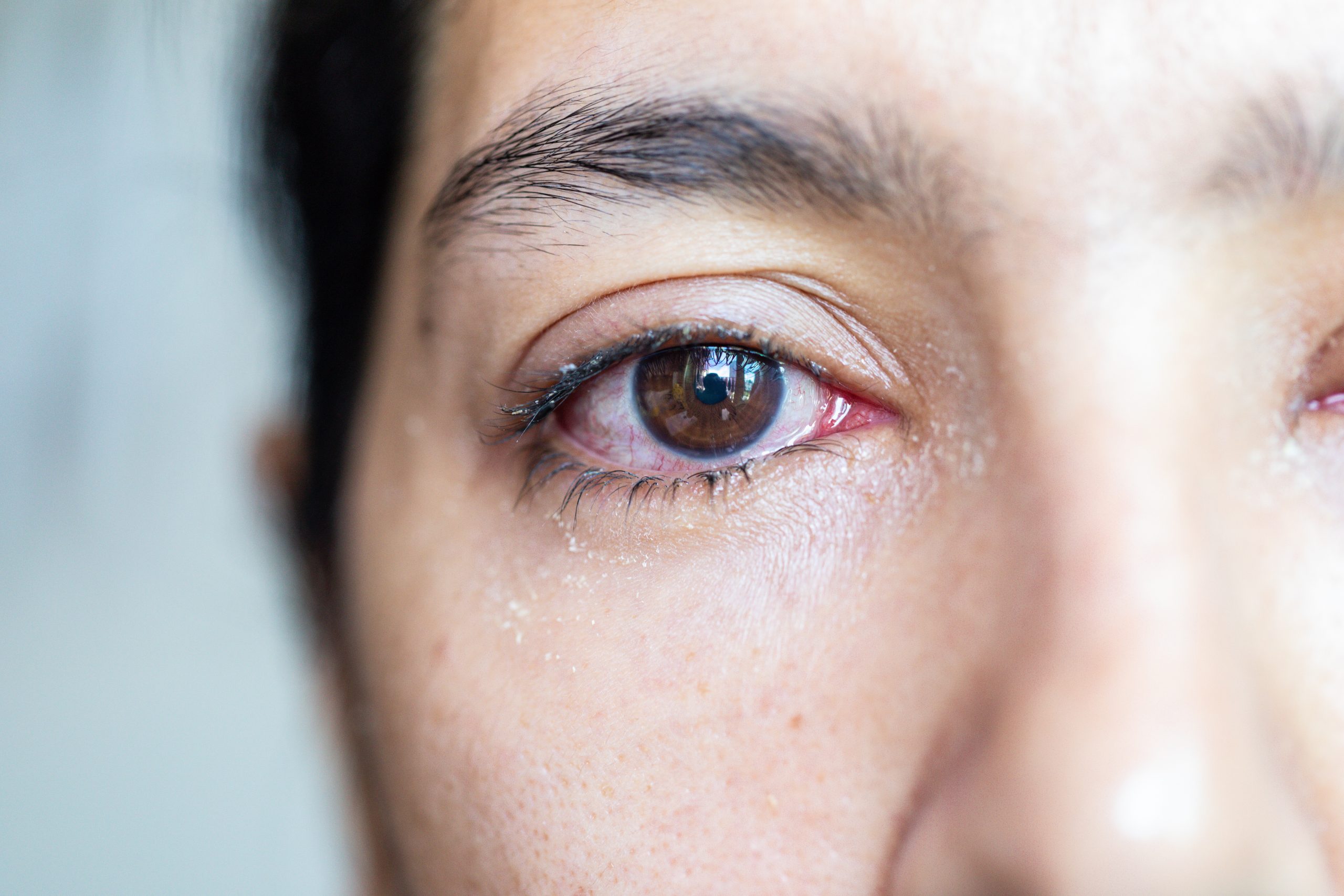 Homöopathie: Augenreizung - © kowitstockphoto/stock.adobe.com