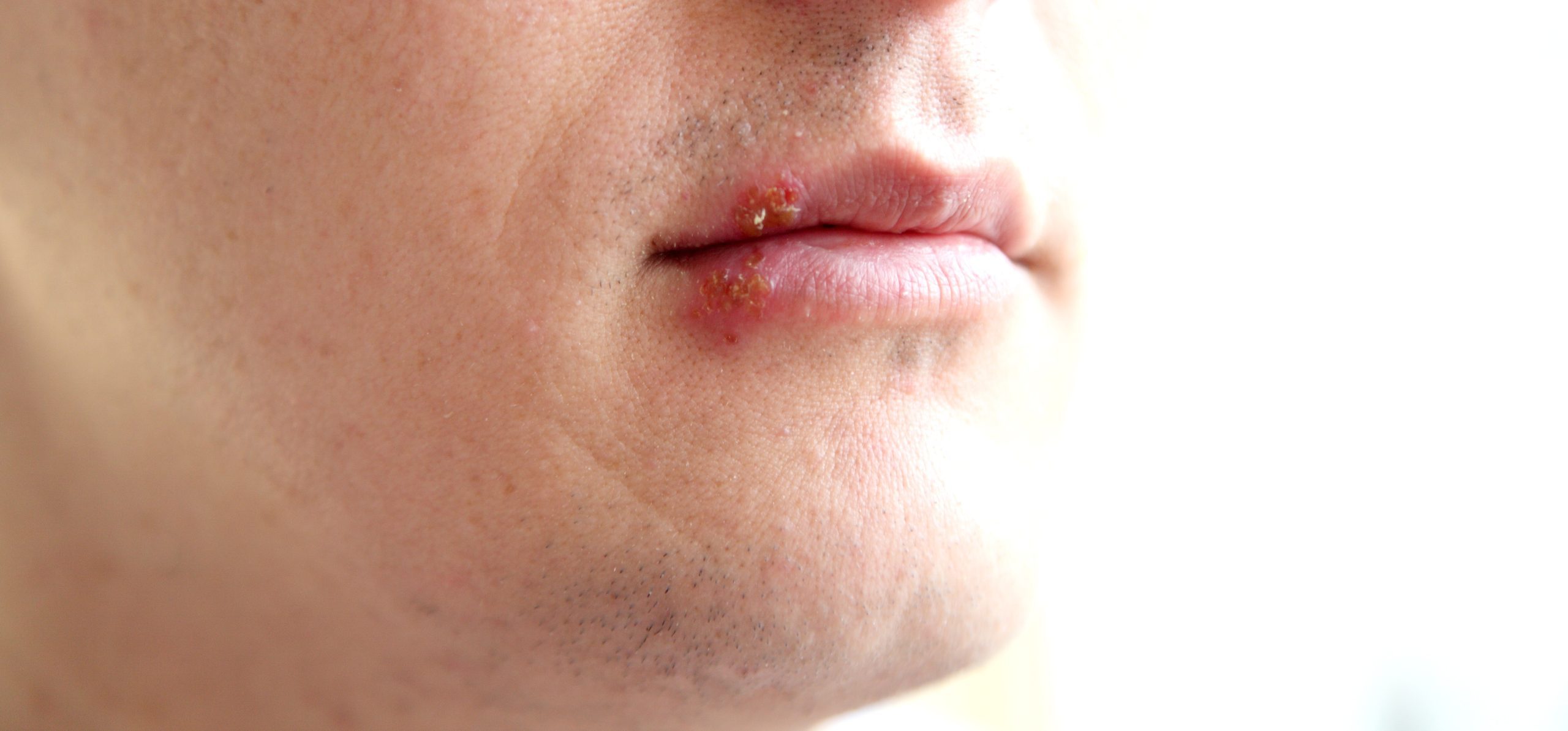 Homöopathie: Herpes - © Pol Maria/stock.adobe.com